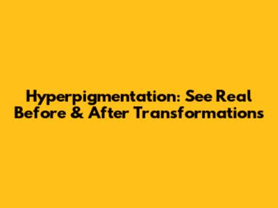 Hyperpigmentation: See Real Before & After Transformations